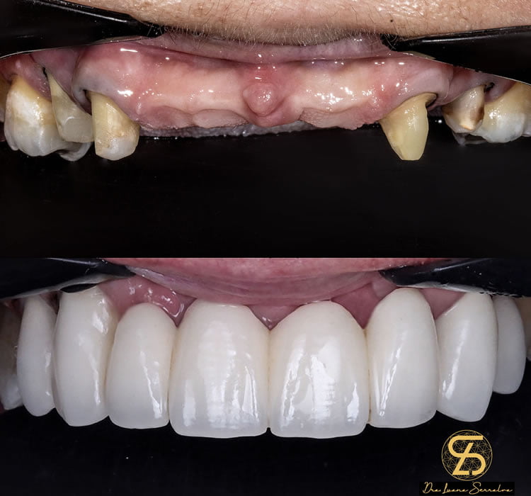 Implante Dentário Barra da Tijuca Dra Luana Serralva