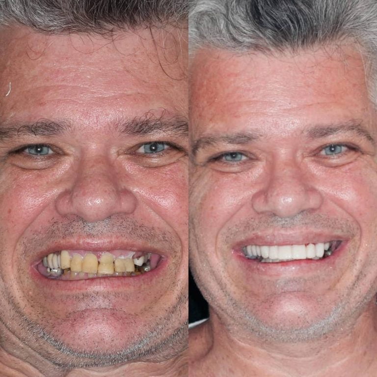 Implante Dentário Barra da Tijuca Rio de Janeiro Dra Luana Serralva