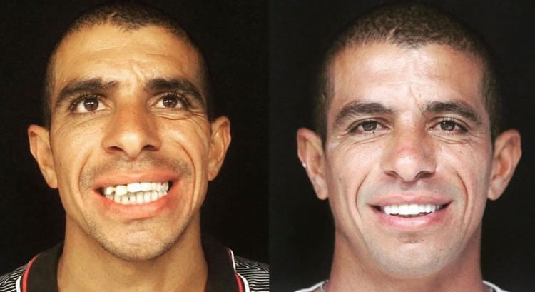 Implante Dentário RJ Dra Luana Serralva