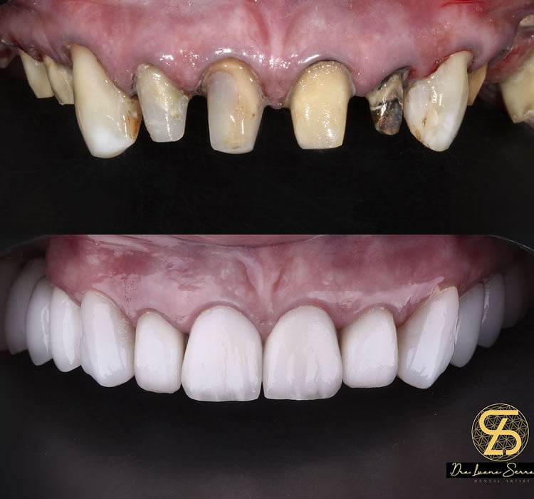 Implante Dentário Recreio Dra Luana Serralva