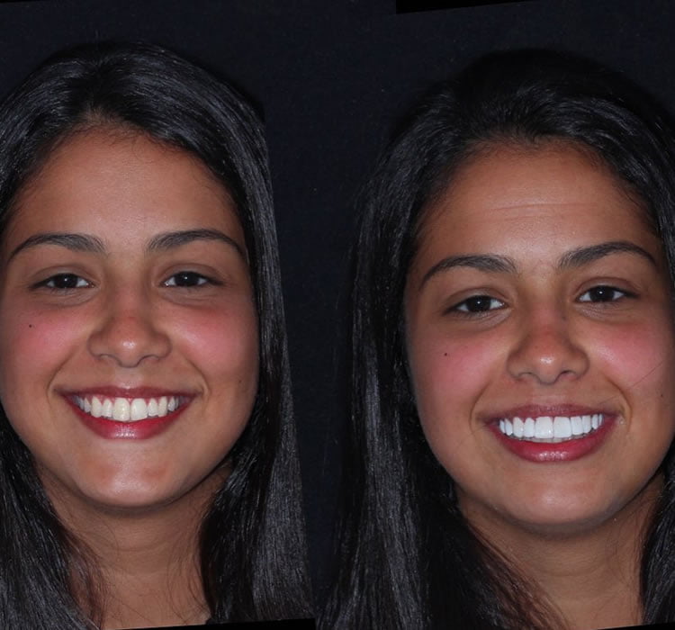 Lentes de Contato Dental Feminina Antes e Depois Dra Luana Serralva