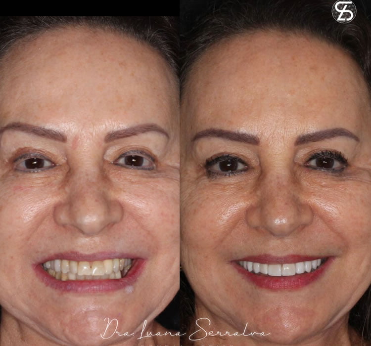 Lentes de Contato Dental Feminina Antes e Depois Dra Luana Serralva1