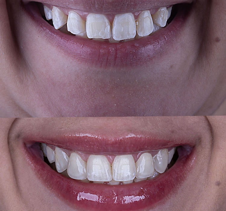 Lentes de Contato Dental Feminino Antes e Depois Dra Luana Serralva