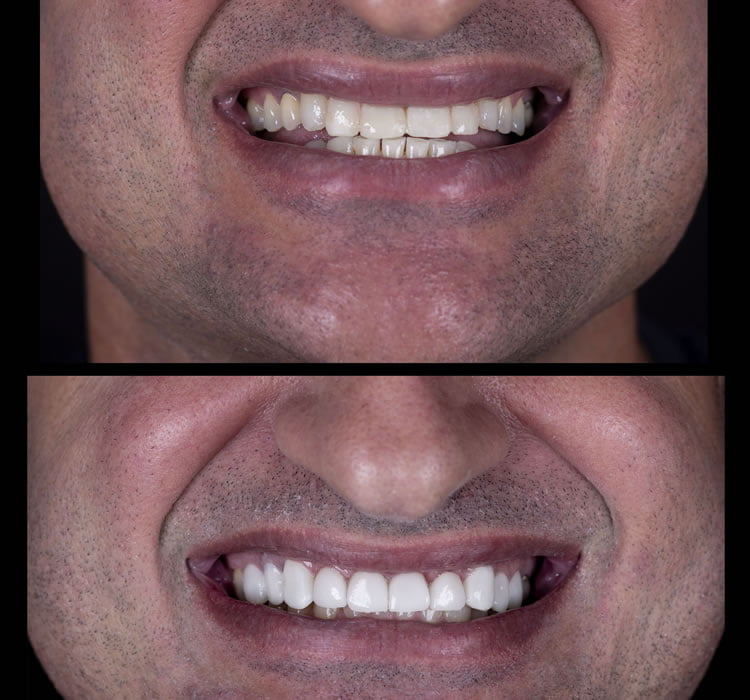 Lentes de Contato Dental Masculino Antes e Depois Dra Luana Serralva