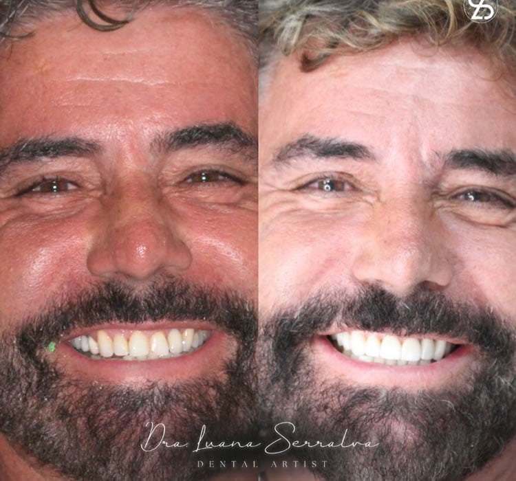Lentes de Contato Dental Masculino Antes e Depois Dra Luana Serralva1
