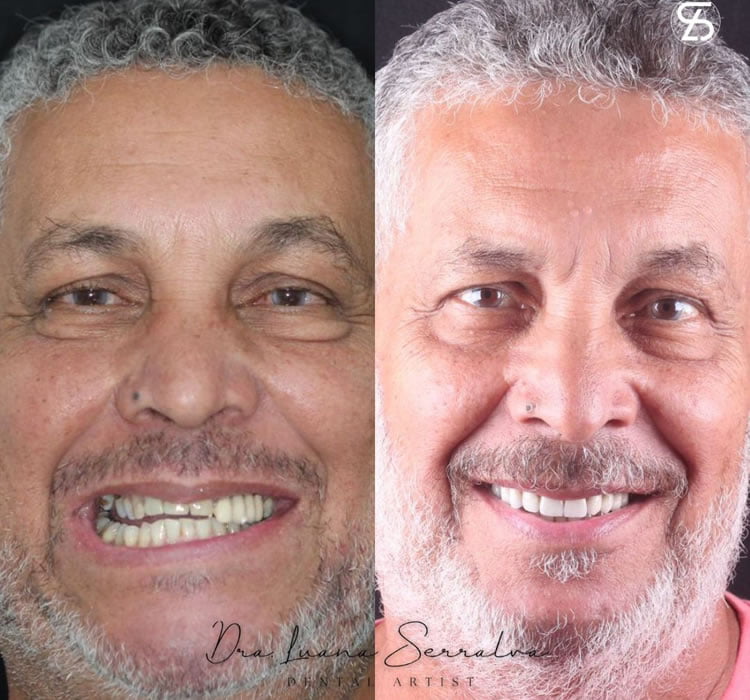 Lentes de Contato Dental Masculino Antes e Depois Dra Luana Serralva2