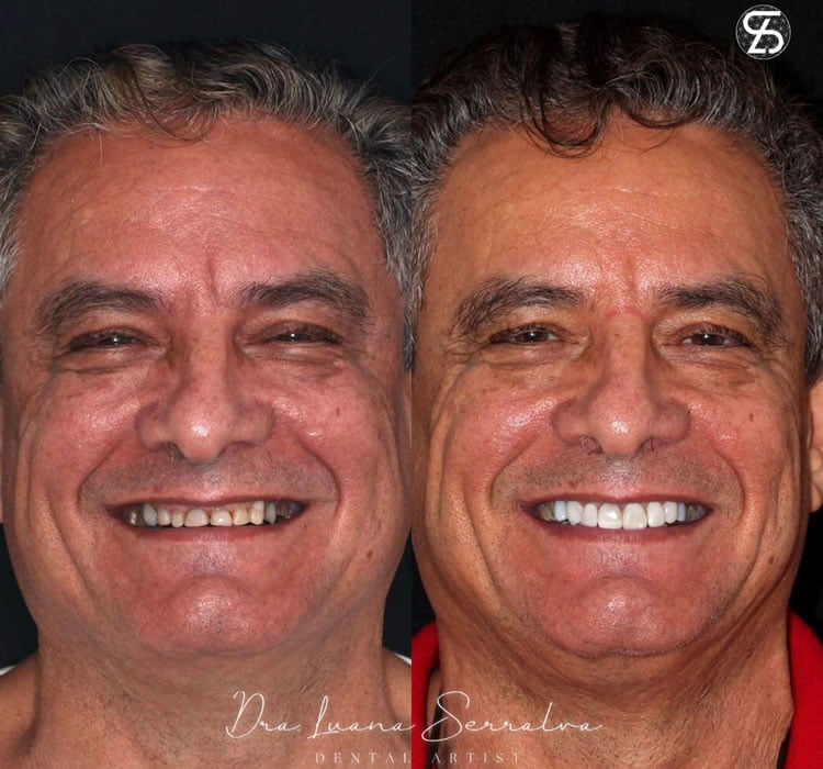 Lentes de Contato Dental Masculino Antes e Depois Dra Luana Serralva3