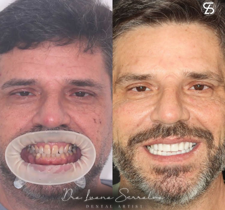 Lentes de Contato Dental Masculino Antes e Depois Dra Luana Serralva4