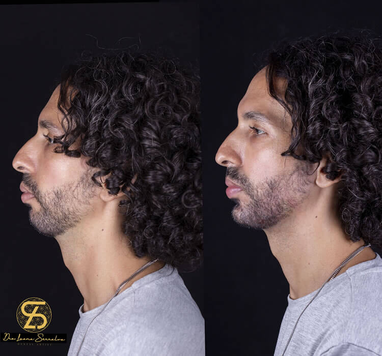 Mandíbula Masculina RJ Dra. Luana Serralva