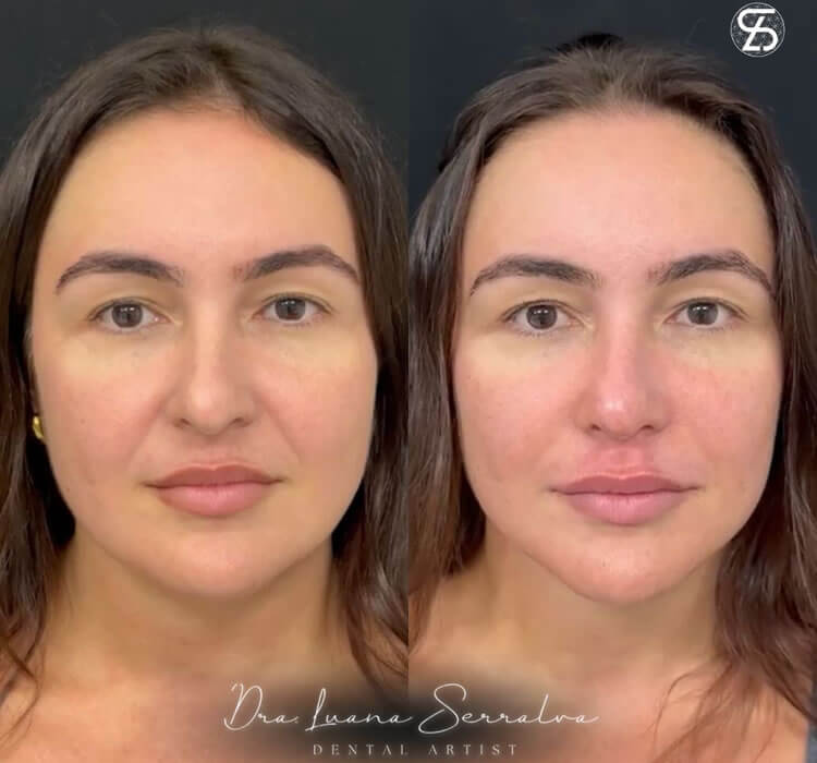 Preenchimento Labial Dra. Luana Serralva