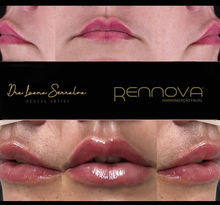 Preenchimento Labial RJ Dra. Luana Serralva