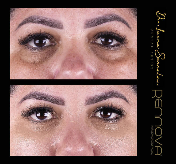 Preenchimento de Olheira Femnina Dra. Luana Serralva