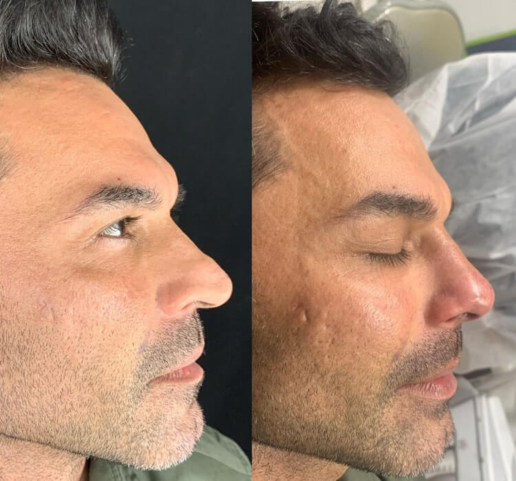 Rinomodelação Facial Dra. Luana Serralva