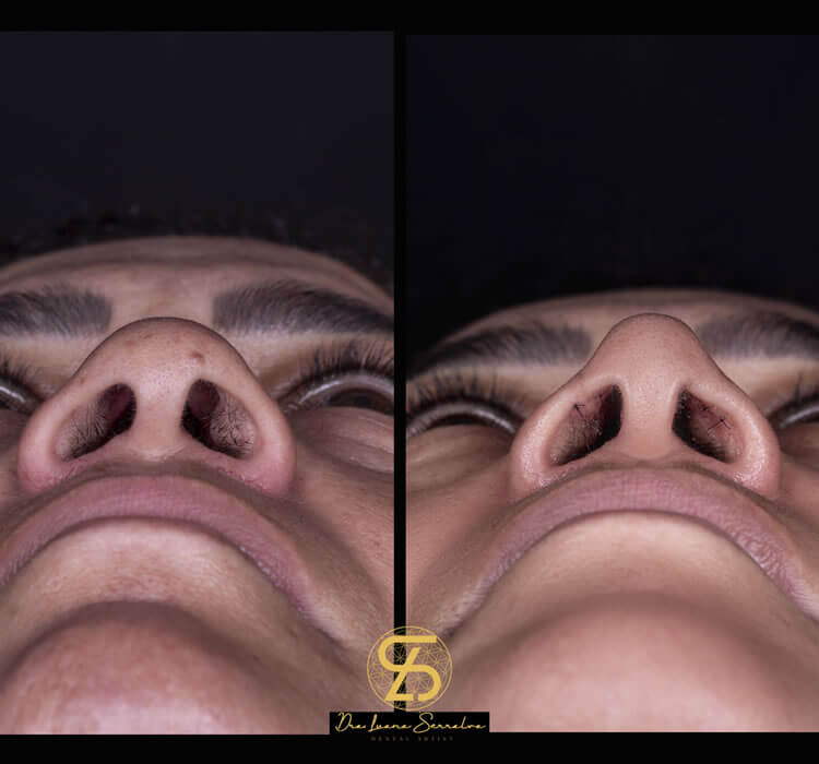 Rinomodelação Femnina Dra. Luana Serralva