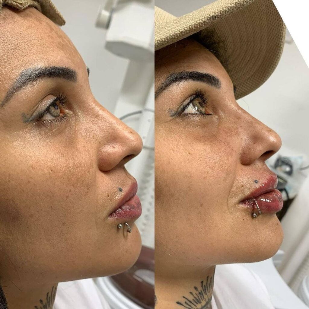 Preenchimento Labial Dra Luana Serralva