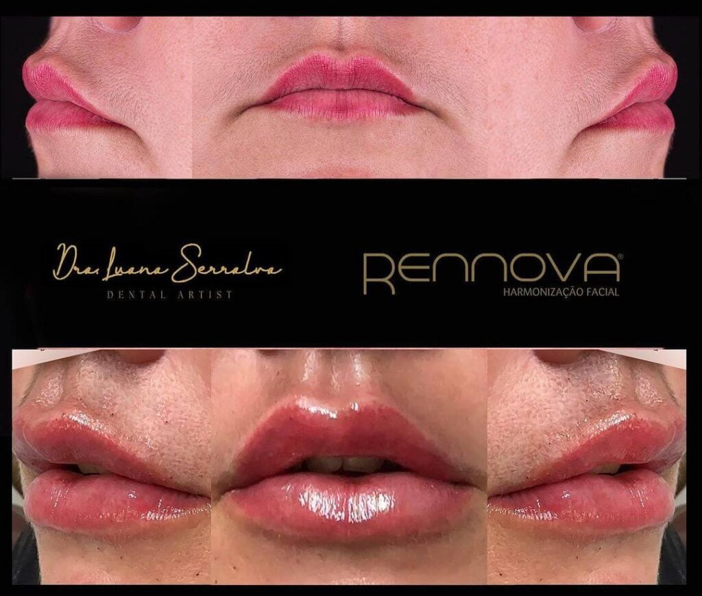 Preenchimento Labial Dra Luana Serralva Barra da Tijuca