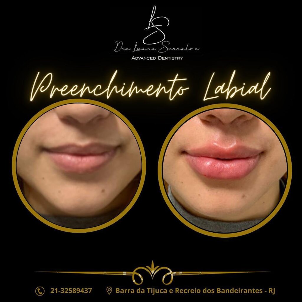 Preenchimento Labial Dra Luana Serralva Recreio