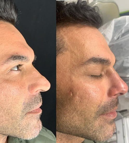 Rinomodelação Dra. Luana Serralva